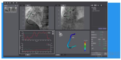 三證齊發,脈流科技心腦血管病功能學評估產品獲nmpa認證